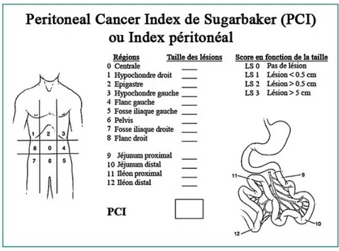 Figure 1: calcul de l'index péritonéal selon Sugarbaker