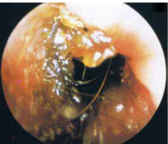 Figure 2 : Production excessive de cérumen et obstruction partielle du conduit auditif externe d’un  chien par otoscopie d’après[19] 