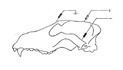 Figure 10 : Représentation schématique du positionnement des électrodes dans le cas d’un montage  ipsilatéral d’après[58][48] 