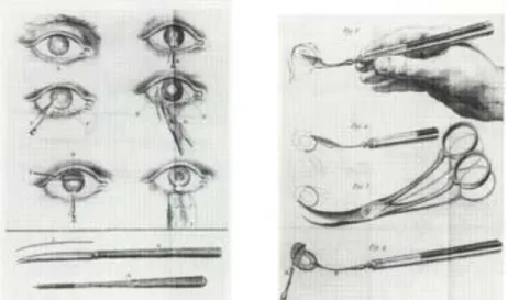 Figure 9. Technique de Daviel (39). 
