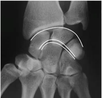 Figure 12 : radiographie de face d’un poignet normal. Respect des arcs de Gilula (courbes  blanches), d’après (4)