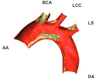 Figure 1 Half aortic arch segmented from synchrotron data; red corresponds to  the artery wall, with atherosclerotic plaque in yellow