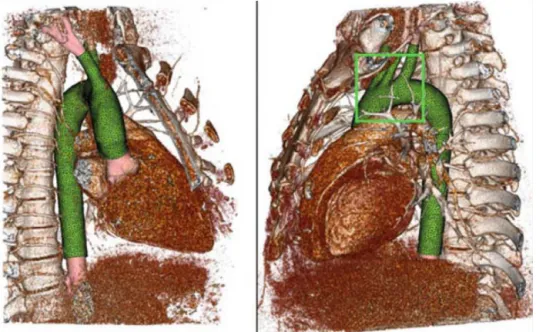 Figure 3 Computed tomography volume rendering, segmentation, and associated computational mesh