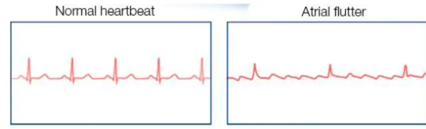 Figure 3 : Battements d'un coeur normal vs d'un coeur subissant un flutter atriale 
