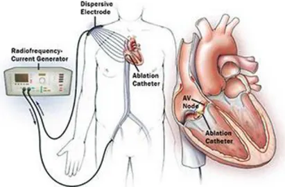 Figure 6 : Pose d'un défibrillateur automatique implantable 