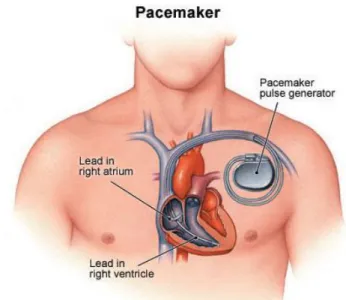Figure 7 : Pose d'un stimulateur cardiaque - pacemaker 