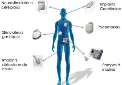Figure 12 : Dispositifs médicaux implantables actifs 