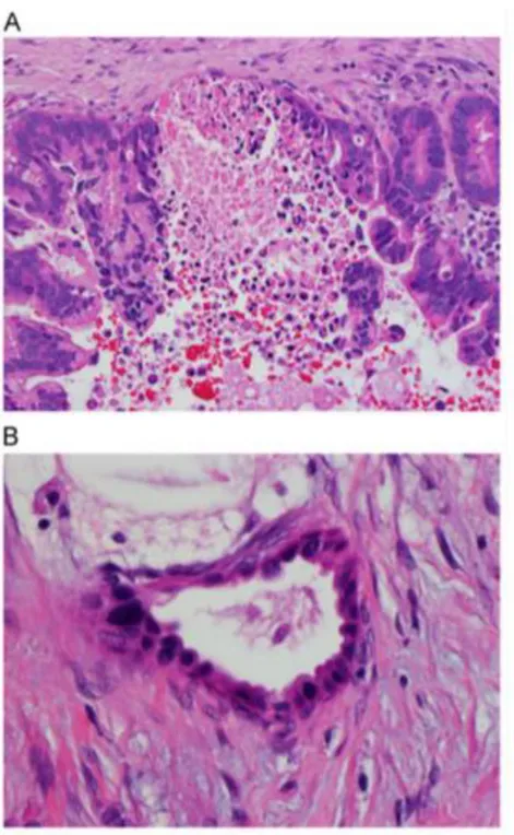 Fig. 4.  Autres exemples caractéristiques de l’adénocarcinome canalaire : (A) nécrose  intraluminale  et  lumière  glandulaire  incomplète  (B)  variation  de  taille  de  noyaux  cellulaires  d’une glande de plus de 4 pour 1 en ratio