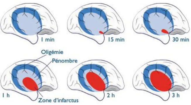 Figure 4 : les différentes zones de l’ischémie cérébrale et leur évolution dans le temps(21) 
