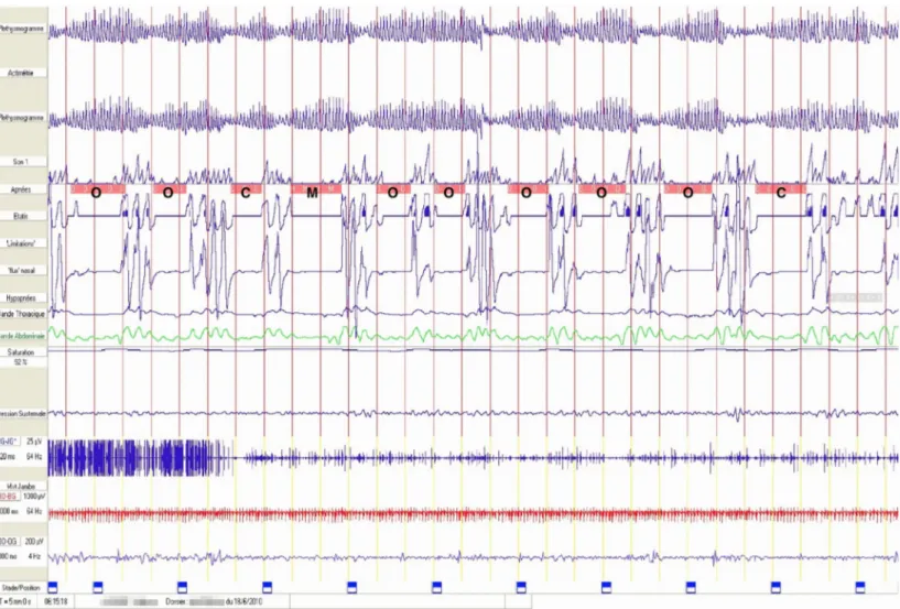 Figure     :      Exemple  d’une  polysomnographie  montrant  des  apnées  obstructives  (O), centrales (C) et mixtes (M)(13)