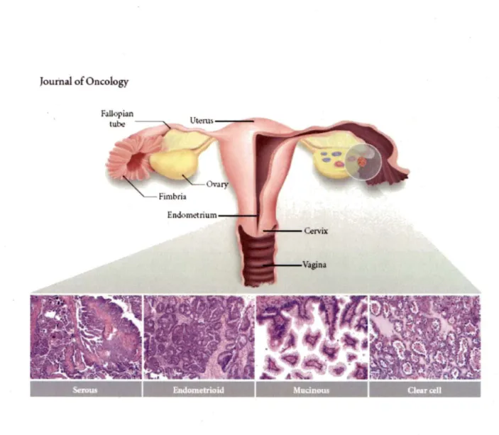 Figure 2. The major histologie subtypes of ovarian carcinoma (KARST and DRAPKIN,  2010)