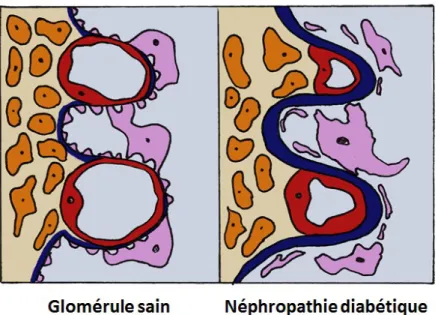 Figure 2. Caractéristiques glomérulaires de la néphropathie diabétique