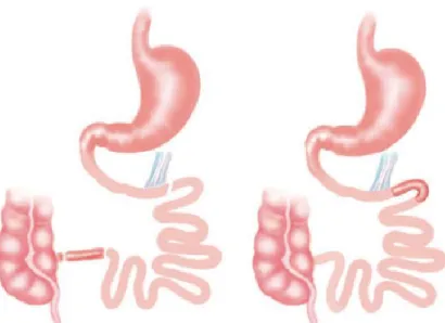 Figure 6  Schéma  anatomique  de  la  transposition  iléale  (Rubino  et  al., 2010)9 