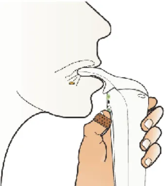 Figure 8 : Dispositif d'administration du Zalviso ®  et éjection d'un comprimé  orangé de sufentanil sublingual 