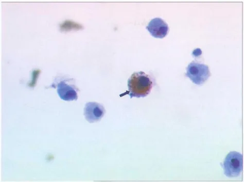 Figure 9 Macrophages (au microscope optique) avec vacuoles dans un liquide de lavage broncho-alvéolaire (19)