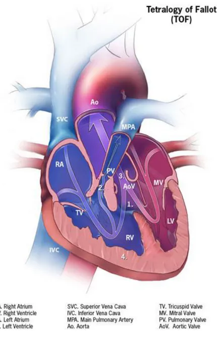 Figure  3.  Anatomie  d’un  cœur  avec  une  tétralogie  de  Fallot  (sténose  pulmonaire)  (d’après  « Centers for Disease Control and Prevention,  National Center on Birth Defects  and Developmental Disabilities ») (29)