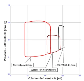 Figure 1.  a. LV pressure-volume loops in normal physiology (red), severe systolic left heart failure (dark red) and when systemic  circulation is supported by VA ECMO 4 L/min (black)