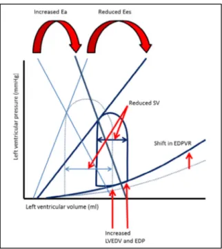 Figure 2 : Boucle pression – volume systolo-diastolique du VG en situation physiologique (pointillé), et en choc  cardiogénique (trait plein)