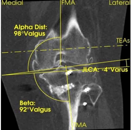 Figure 5 : Coupe Frontale en TDM du genou natif, évaluation des angles alpha, bêta et  l’angle d’ouverture des interlignes fémoro-tibiales (JLCA)