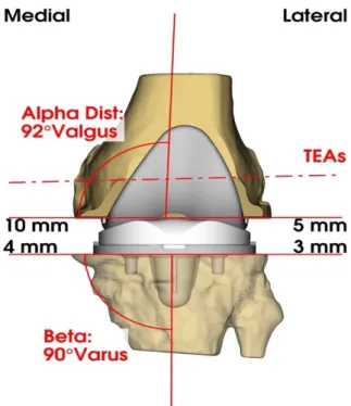 Figure 8 : Modélisation 3D de la prothèse totale de genou avec les angles alpha, bêta  postopératoires et les épaisseurs des coupes prédéfinies