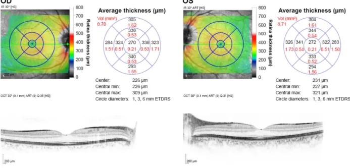 Figure 8 – OCT maculaire sur HD-OCT Heidelberg Spectralis® présentant une cartographie  couleur, un mapping par quadrants ETDRS et une coupe fovéolaire horizontale des deux yeux