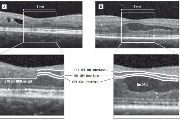 Figure 12 – Visualisation par OCT des interfaces rétiniennes à observer pour définir la présence ou  l’absence d’un DRIL – Issue de l’article « Disorganization of the Retinal Inner Layers as a Predictor  of Visual Acuity in Eyes With Center – Involved Diab