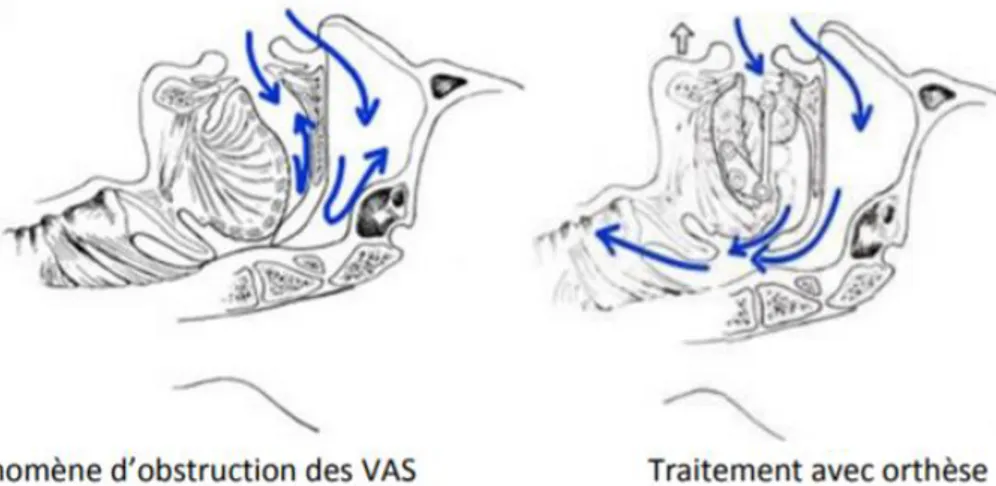 Figure 8 : Schéma du passage de l’air dans les voies aériennes supérieures avec et  sans orthèse d’avancée mandibulaire 