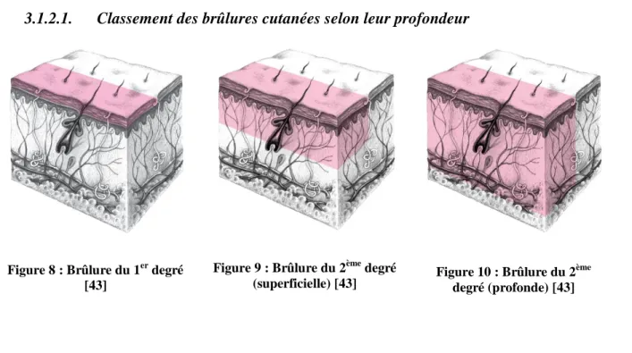 Figure 8 : Brûlure du 1 er  degré  [43]