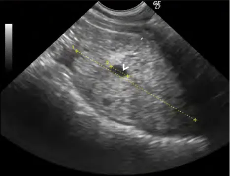 Fig 9. Image échographique d’une hyperplasie de la prostate associée à la  présence d’un kyste prostatique (flèche blanche) en coupe longitudinale (Service 