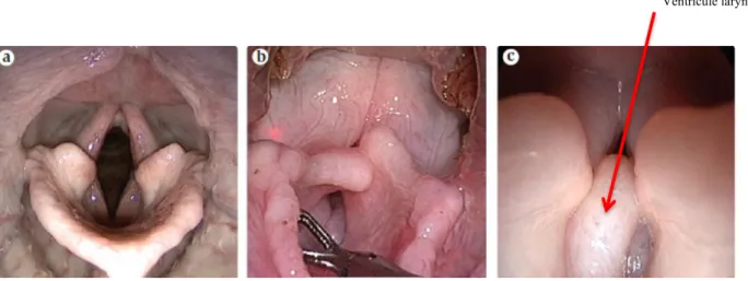 Figure 5 : Photographies de larynx réalisées en endoscopie. La photographie a) est celle d’un larynx normal de chien mésocéphale  (pas de collapsus), la photographie b) est celle d’un larynx de chien brachycéphale présentant un collapsus laryngé de stade 3
