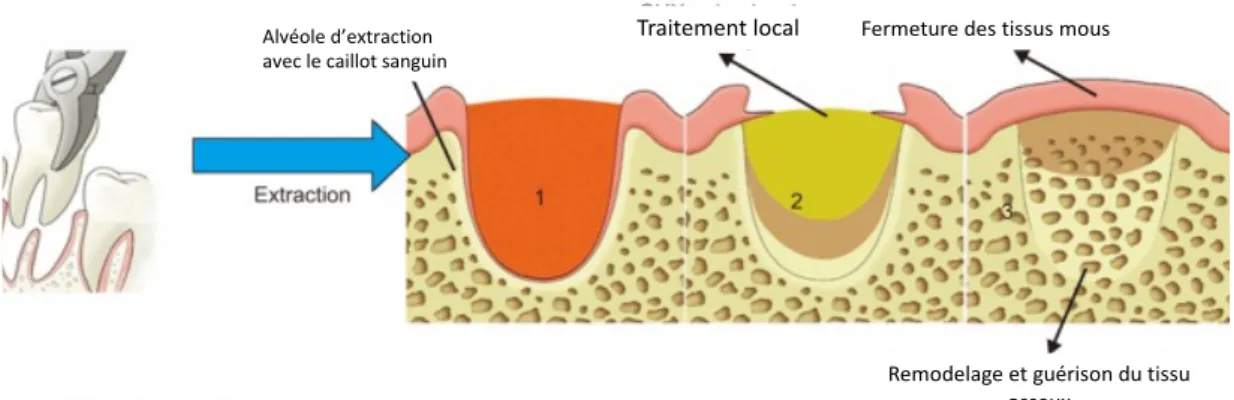 Figure 5) Processus de guérison d’une alvéole d’extraction par un  traitement local (50) 
