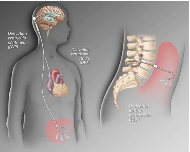 Figure  8 :  Illustration  des  différentes  méthodes  de  shunt  ventriculaire.  Dérivations  ventriculo-péritonéale  et  ventriculo-atriale  (à  gauche),  dérivation  lombo-péritonéale  (à  droite)