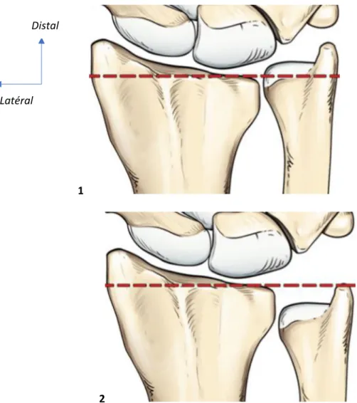 Figure 7 : Illustration tirée de l’ouvrage « arthroscopic management of ulnar pain ». Variance  ulnaire positive (1) et négative (2)