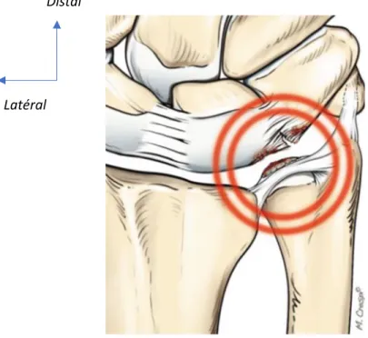 Figure 11 : Illustration tirée de l’ouvrage « arthroscopic management of ulnar pain »