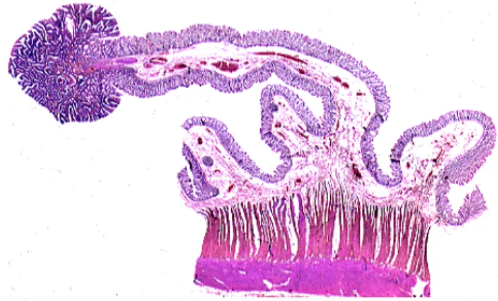 Figure 7 : Chirurgie mini-invasive d’un  polype par coloscopie
