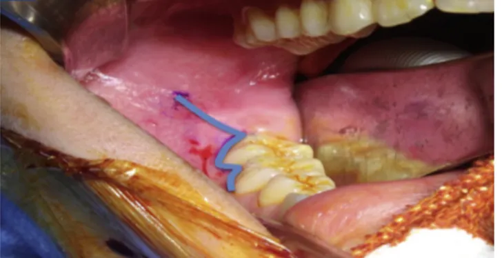 Figure 3 : Photo intra-buccale représentant le trajet d’incision muco-périostée [55] 