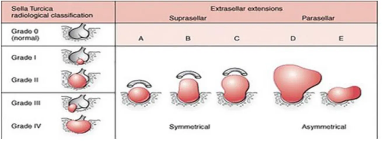 Figure 1 : Classification des adénomes selon Hardy