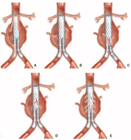 Figure 4 : Types d’endofuites : Type I (A), II (B), III (C), IV (D) et V (E), Cochennec et al (5)