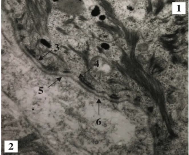Figure 1 : JDE en microscopie électronique : (1) Epiderme (2) Derme (3) Membrane cytoplasmique  (4) Lamina lucida (5) Lamina densa (6) Zones des fibrilles d’ancrage  (clichés du Professeur Prost) [1] 