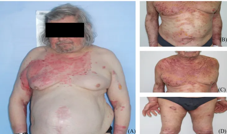 Figure 9 : Bulles tendues et érosions post-bulleuses prédominante sur le haut du corps (A) Service de Dermatologie,  hôpital Saint Vincent de Paul (B)(C)(D), Photographies recueillies avec l’aimable autorisation du Pr A.Pham-Ledard, 