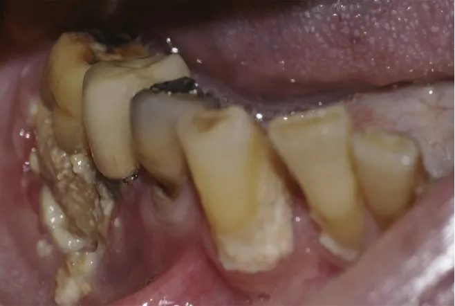 Figure 4 : photo intrabuccale d'une ostéonécrose mandibulaire (46).