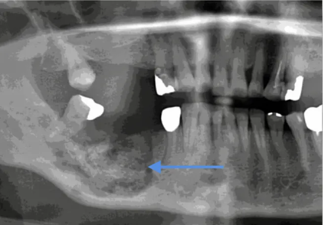 Figure 6 : cliché radiographique de l'ostéonécrose mandibulaire de la                    figure 5 (51).