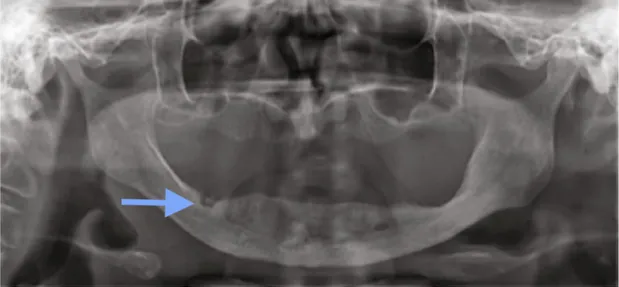 Figure 9 : cliché radiographique de l'ostonécrose de stade 0 de la figure 8        (52).