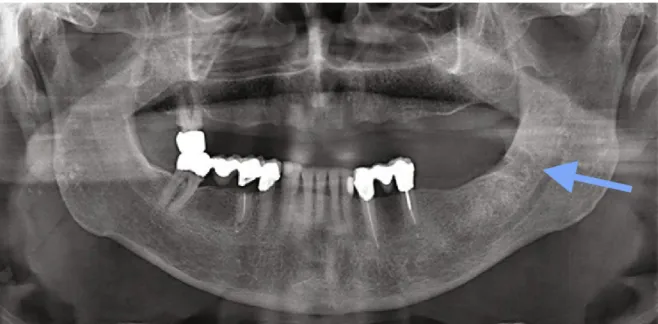 Figure 11 : cliché radiographique de l'ostonécrose mandibulaire de stade 1                    de la figure 10 (52).