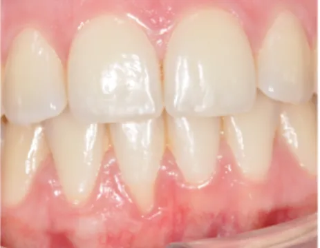 Figure 1 : Photographie de récession tissulaire marginale sur la dent 41   (Courtoisie du Dr PETIT)