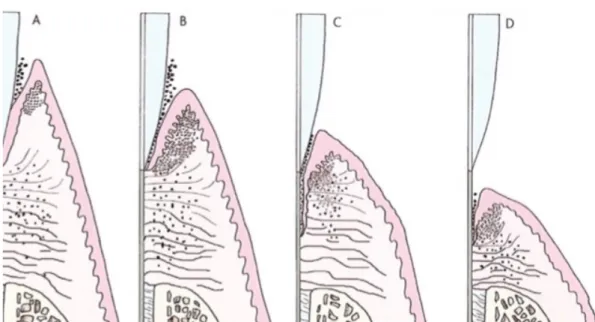 Figure 7 : Schéma de la pathogénicité d’origine bactérienne de la récession tissulaire  marginale (22).