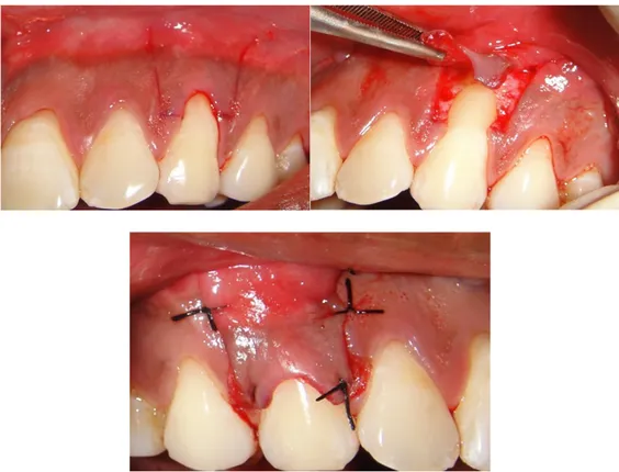 Figure 8 : Photographie d’un lambeau positionné coronairement réalisé sur la 23 (17). 