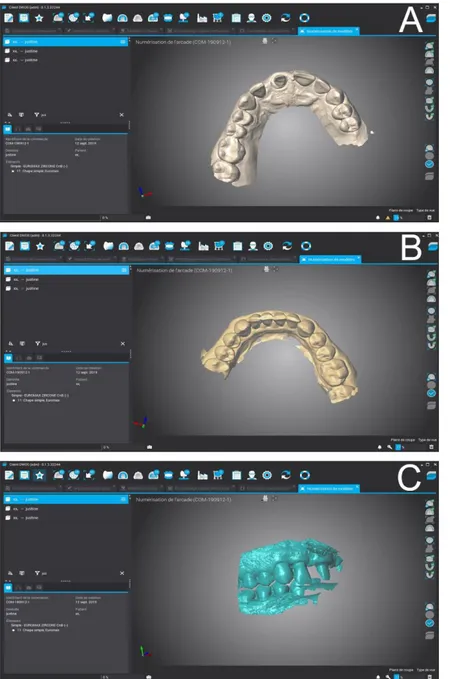 Figure 11: A: modèle numérique maxillaire du 2 e  cas clinique sur le logiciel DWOS de  Dental wings; B: modèle numérique mandibulaire du 2 e  cas clinique; C: modèles 
