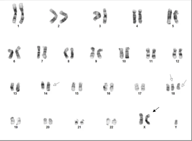 Figure 8. Caryotype d’un LF : 48,XY,+X,t(14;18)(q32;q21),+18 - Caryotype complexe de type  masculin  mettant  en  évidence  un  clone  anormal  à  48  chromosomes  caractérisé  par  une  translocation  réciproque  t(14;18)(q32;q21)  associée  à  une  triso