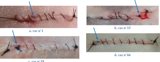 Figure 19  : Observation du fil de suture sous-cutané dans différents cas 
